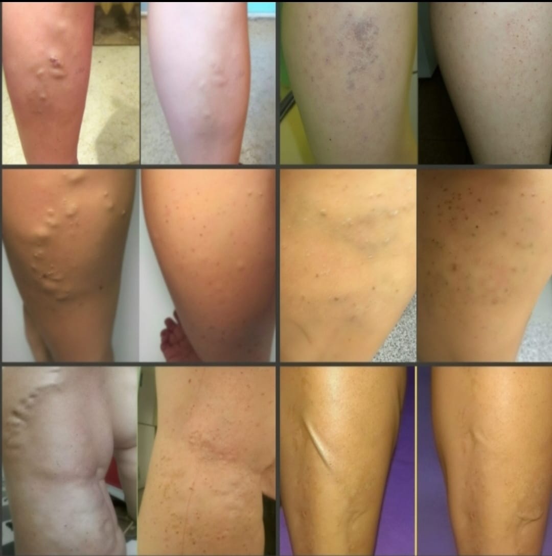 Antes e depois do tratamento de varizes